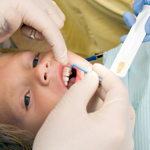 Topical Fluoride Treatment