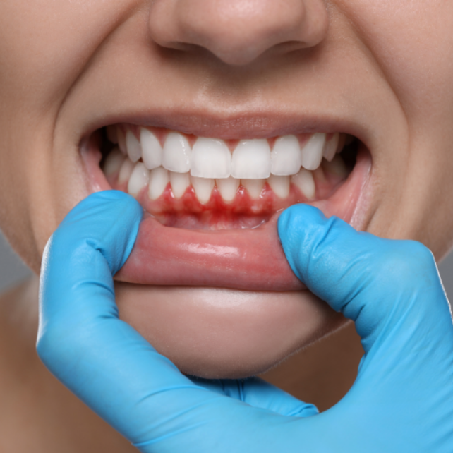 Understanding Receding Gums