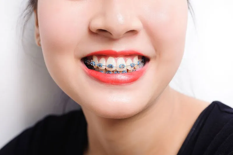 braces cost in singapore