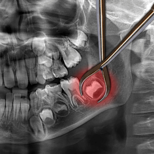 A Cost Breakdown of Wisdom Tooth Extraction in Singapore