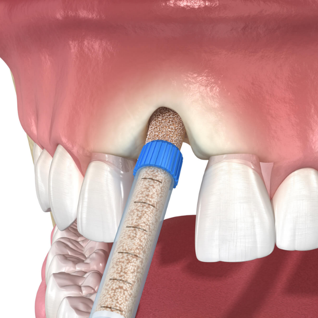 Bone Grafting