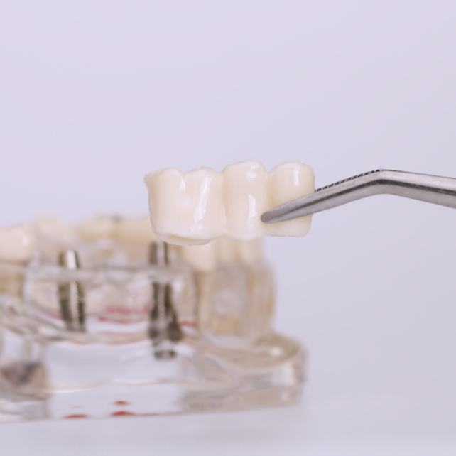 Dental Bridge