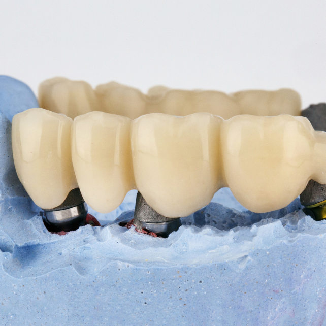 Dental Bridges