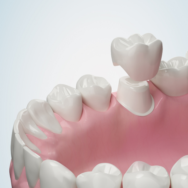 Dental Crown in Singapore