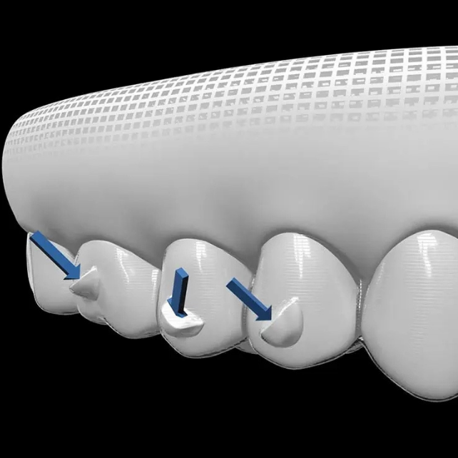 Invisalign Attachments