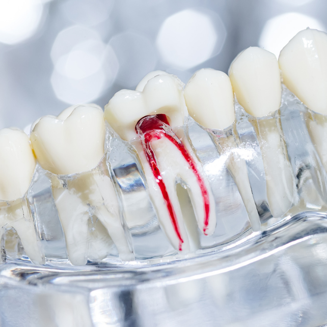 Root Canal Treatment Cost